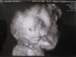 My son in the second trimester at 18 weeks.